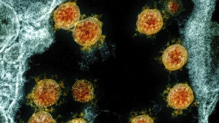 Sars-CoV-2-Infektion: 613 Tage lang Corona: Forscher stellen seltenen Infektionsfall vor